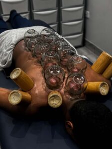 Cupping Therapy Coventry
